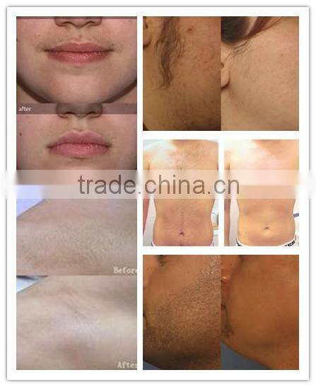 Newest SHR Two Handles Hair Removal IPL SHR Hair Removal Laser