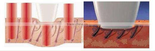 professional micro channel skin rejuvenation fast hair removal 808nm laser diode