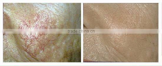 removal of lesions of the capillaries