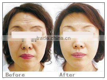 Fractional rf and microneedle for skin rejuvenation wrinkle removal