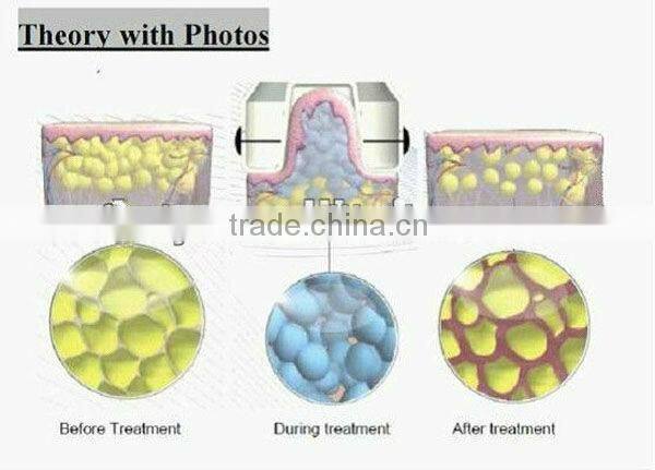 Lipo Cryo Max Machine With RF And Ultrasound
