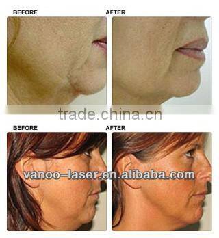 hot sale salon use wrinkle removal rf machine