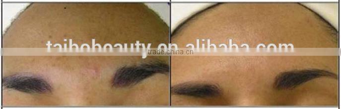 Water Oxygen Jet Peel spa system machine oxygen for aesthetic/oxygen jet facial machines/oxygen machines for sale