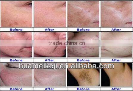 distributer wanted IPL beauty machine with CE,TGA certificates