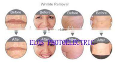 full power portable ipl hair removal machine really works