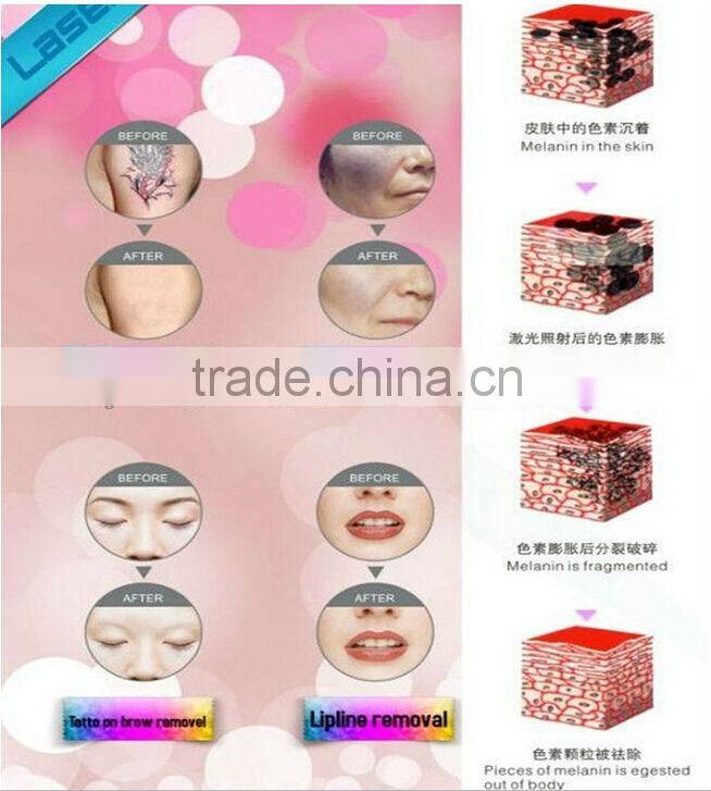 Hot selling!! professional Acne removal laser 532 1064 nd yag q switched