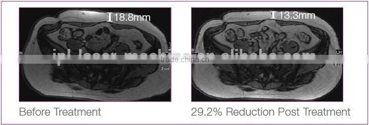 Newest High Intensity focused ultrasound hifu therapy hifushape HIfu slimming
