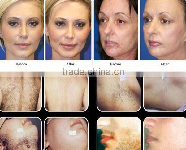 hair removal epilator pulsed light ipl