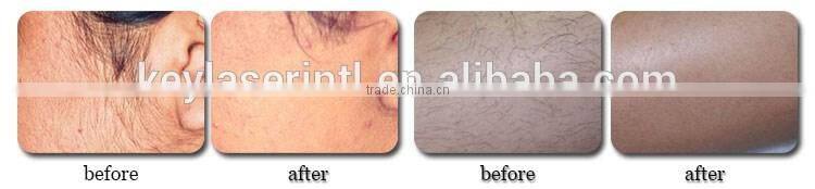 Best price 1 year warranty 50,0000 shot times ipl+rf+e light+anti age equipment