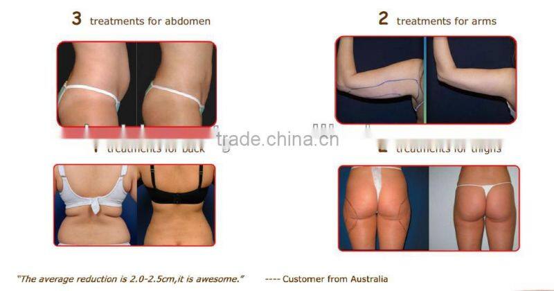 Beir Factory lipolaser slimming /mini lipo cold laser/ 36 diodes lipolaser weight loss pad