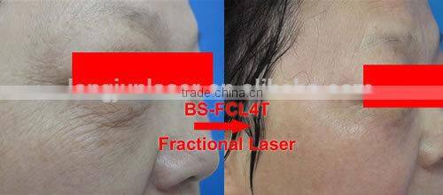 Professional laser equipment /otolaryngology treatment device CE&FDA