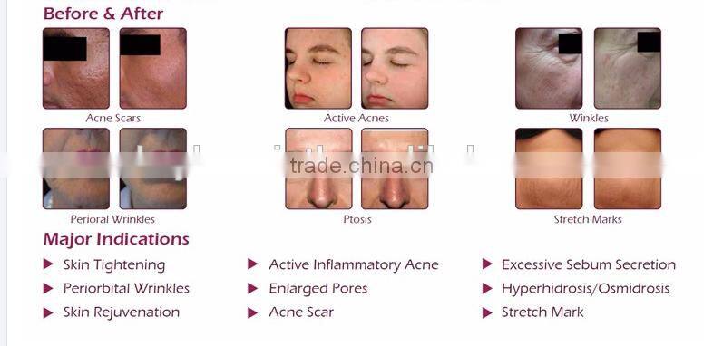 hot sale home use fractional rf for skin care and face lifting machine