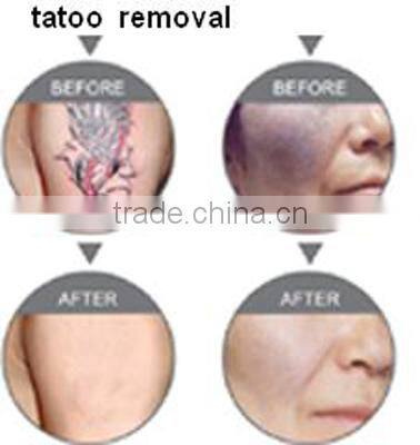 New Designed q switch nd yag laser tattoo removal machine price/ tattoo removal laser