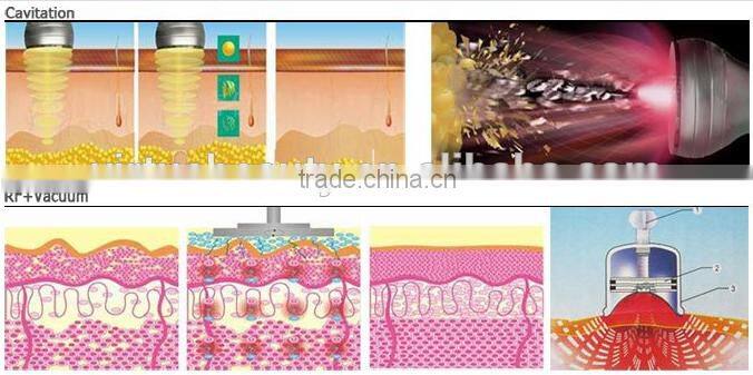 Cryoshape body shaping and slimming with CE approval