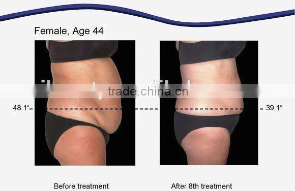 vacuum/ cavitation / RF / Laser fat system / slimming equipment LS650