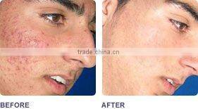 No no hair removal!!!E-light facial hair removal machine for women