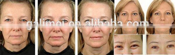 Stand skin rejuvenation/anti-aging inhale oxygen machine/oxygen therapy facial machine