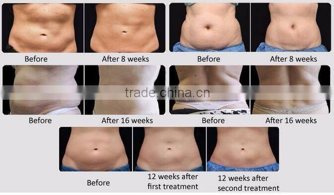 Professional cryolipolysis device/portable cryolipolysis machine price/Cavitation slimming machine