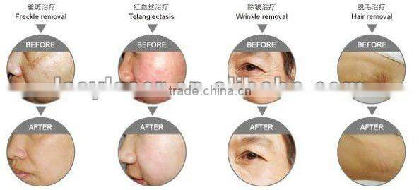YAG+IPL+RF multifuntion Beauty Machine for spa salon