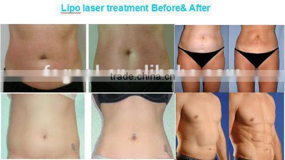 Medical Equipment Beauty Salon Lipo Laser Slimming Machine Fast Cellulite Loss machine for sale
