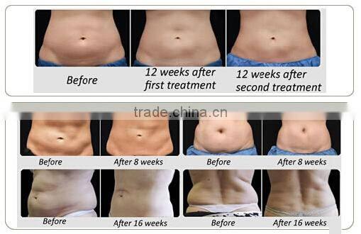 2 Handles work together!!!!! fat freezing slimming portable beauty cryolipolysis machines