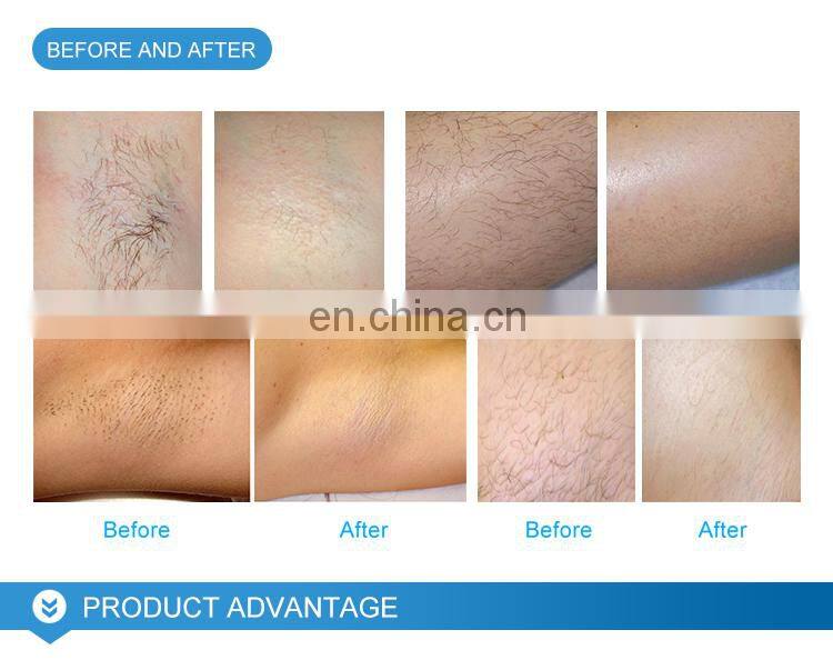 LEFIS Three Wavelength 755nm diode laser 808nm diode laser high quality 808nm diode laser