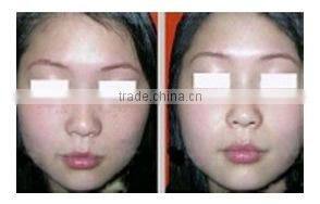 fractional RF beauty equipment for skin lifting wrinkle removal