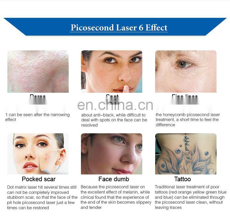 Picosecond tattoo removal laser beauty equipment popular q switched nd yag laser machine for sale