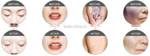 PROFESSIONAL Q SWITCH YAG LASER TATTOO EYEBROW CALLUS REMOVAL / LASER TATOO REMOVER