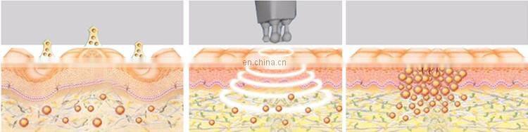 hot sale rf fast vacuum cavitation kim 8 slimming system