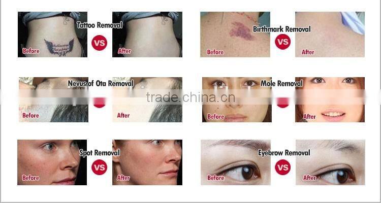 Best-selling nd yag laser pigment removal machine