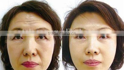 hair removal spray/alexandrite laser hair removal machine