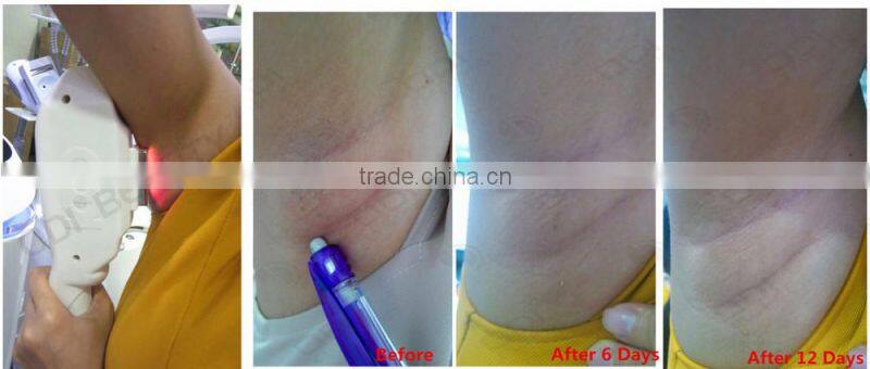 OPT ipl hair removal equipment with 80.000 shots ipl flash lamp