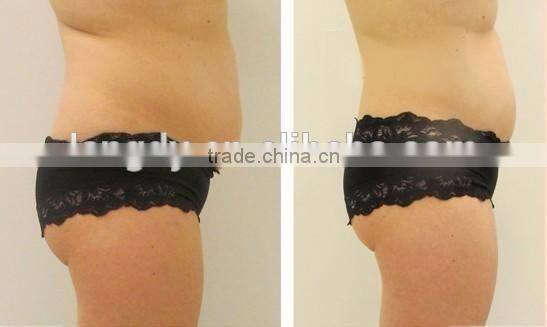 2016 liposonix hifu slimming equipment / liposonix LANGDI ORIGINAL FACTORY