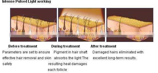 Best SHR/Elight Hair Removal Skin Rejuvenation IPL Machine