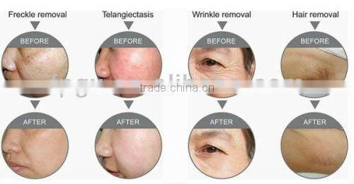 CE Approved IPL Hair Removal Beauty Equipment