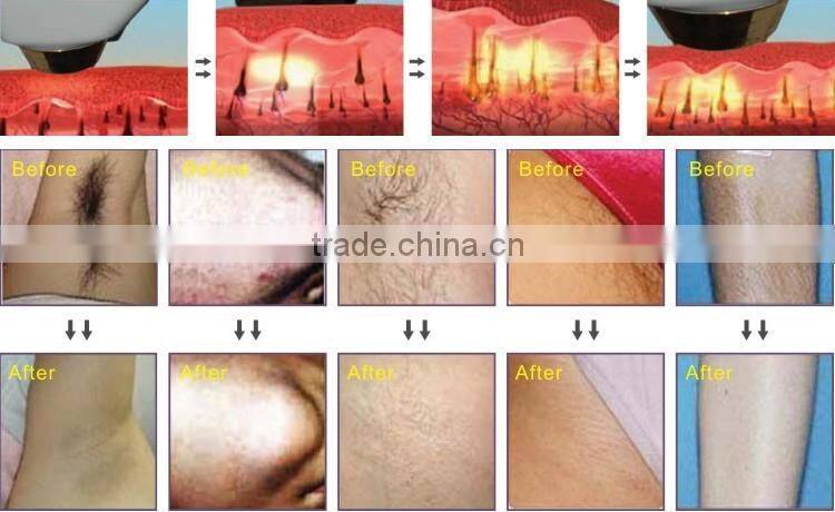Professional laser hair removal machine/808nm diode laser hair removal