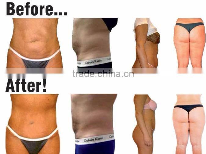 Lipo Laser Fat Reduction Product Body Sculpture Lipo Laser dual wave Medical Diode Laser