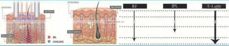 skin rejuvenation elight/ at home skin tightening machine C005