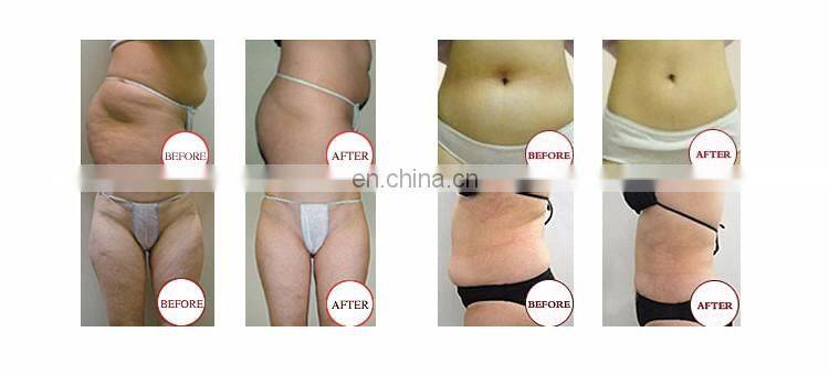 Hot sale cryo weight loss machine cyrolipolysis slimming machine/cryolipo slimming machine