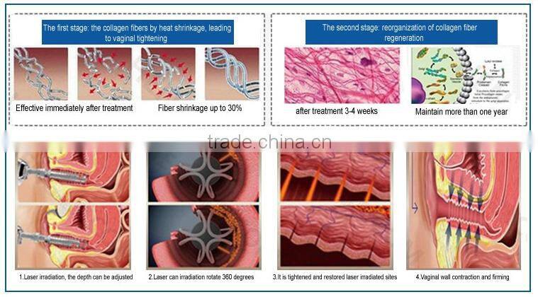 hotsale co2 fractional laser vaginal tightening equipment
