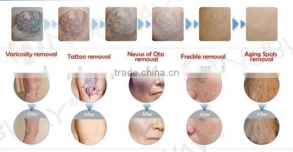 Powerful 1064nm Nd Yag Q Switched Laser Tattoo Removal Machine