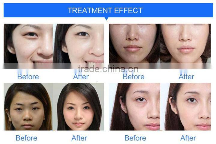 ce approval oxygen Aqua jet peel machine with water spray facial skin scrubber system