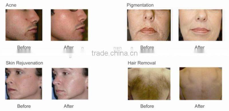 2015 hot sale IPL device IPL hair removal machines- model HS-665