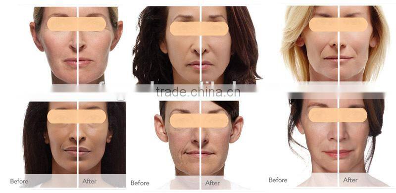 40W skin rejuvenation fractional CO2 medical laser treatment equipment