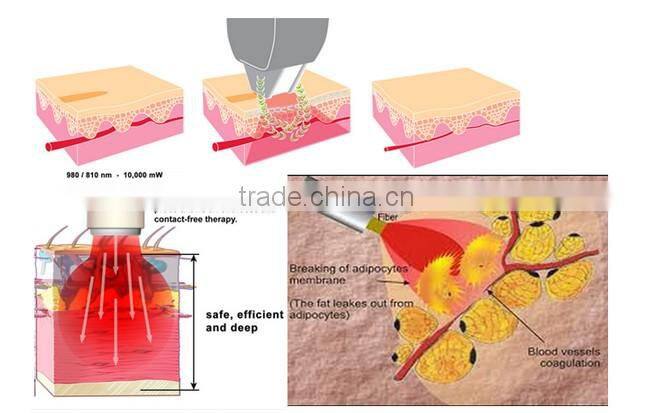 RBS03- Ramya diode laser 980nm RBS vascular vein stopper removal machine