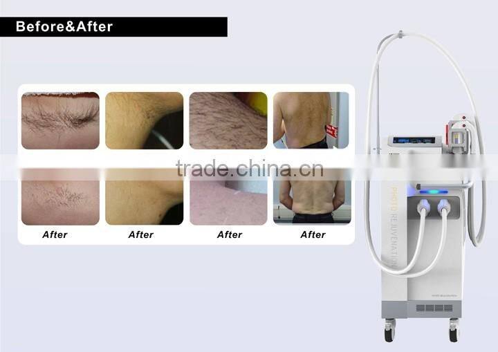 New Year Promotion Vertical IPL OPT SHR hair removal machine