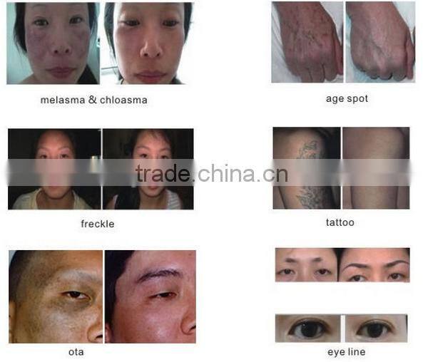 tattoo remover q-switched nd yag laser tattoo remover q-switched nd yag laser black tattoo removal