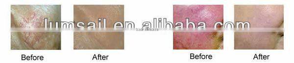 Promotion factory price best beauty device vascular removal for varicose veins spider