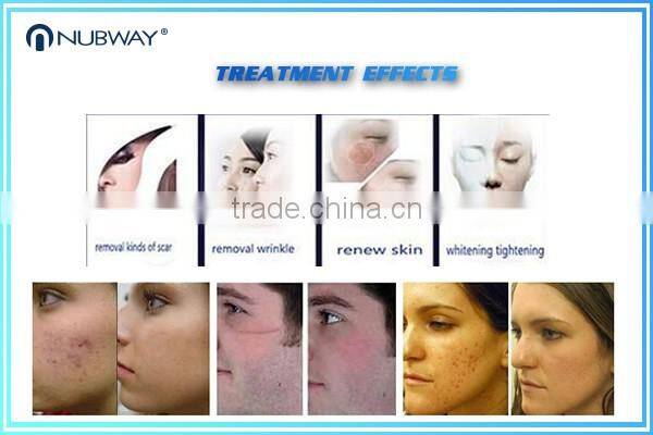 USA Laser Vaginal Tighten Medical Use RF Fractional Co2 Laser